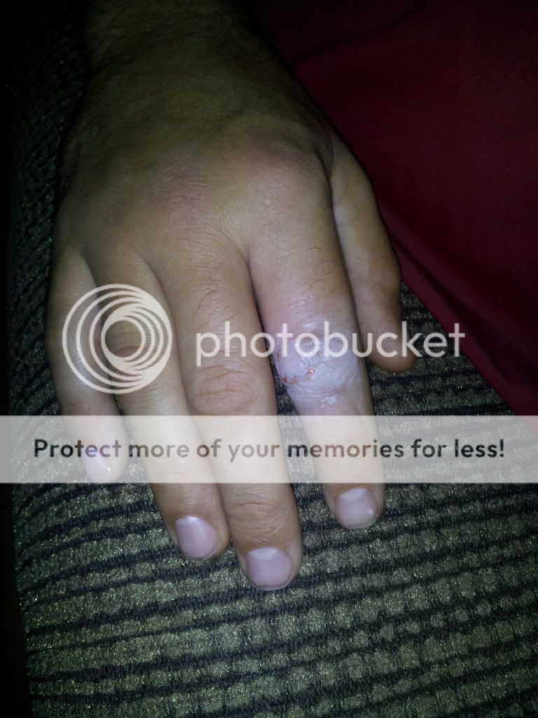 ot dh fractured knuckle. swelling question.*caution pics* BabyCenter