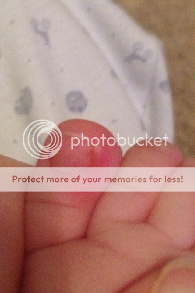 infected-toe-pic-babycenter